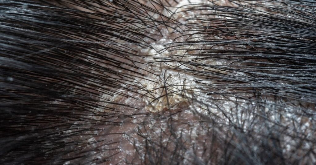 How Often To Wash Hair Scalp Psoriasis