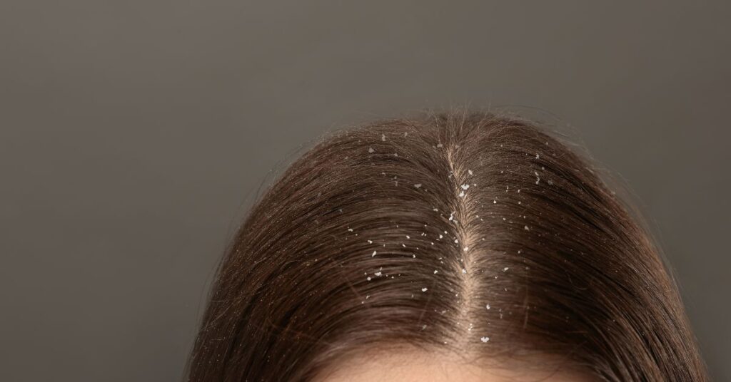 Can Soap Cause Dandruff